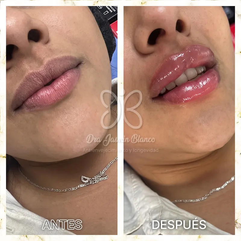 Img-Dra_Jasmin_Blanco-Antes&Despues-Acido_Hialuronico-1 Img-Dra_Jasmin_Blanco-Antes&Despues-Acido_Hialuronico-1