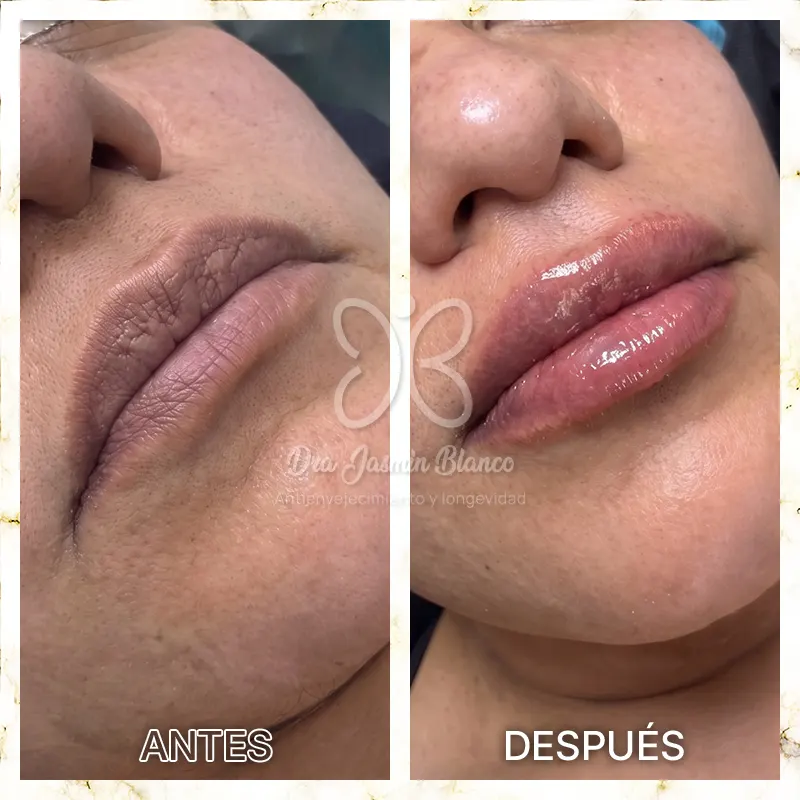 Img-Dra_Jasmin_Blanco-Antes&Despues-Acido_Hialuronico-2 Img-Dra_Jasmin_Blanco-Antes&Despues-Acido_Hialuronico-2
