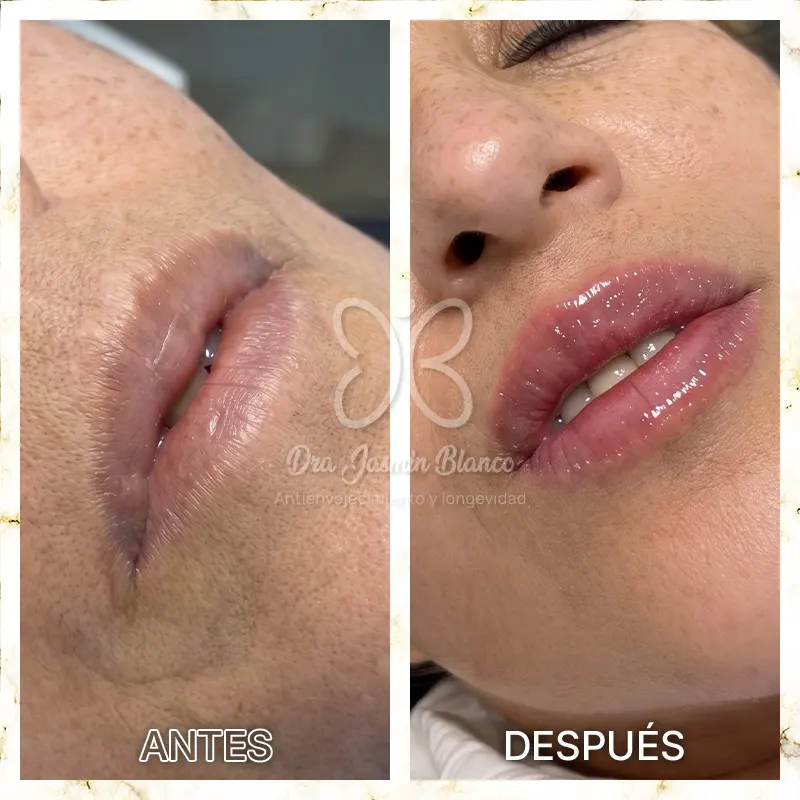 Img-Dra_Jasmin_Blanco-Antes&Despues-Acido_Hialuronico-3 Img-Dra_Jasmin_Blanco-Antes&Despues-Acido_Hialuronico-3