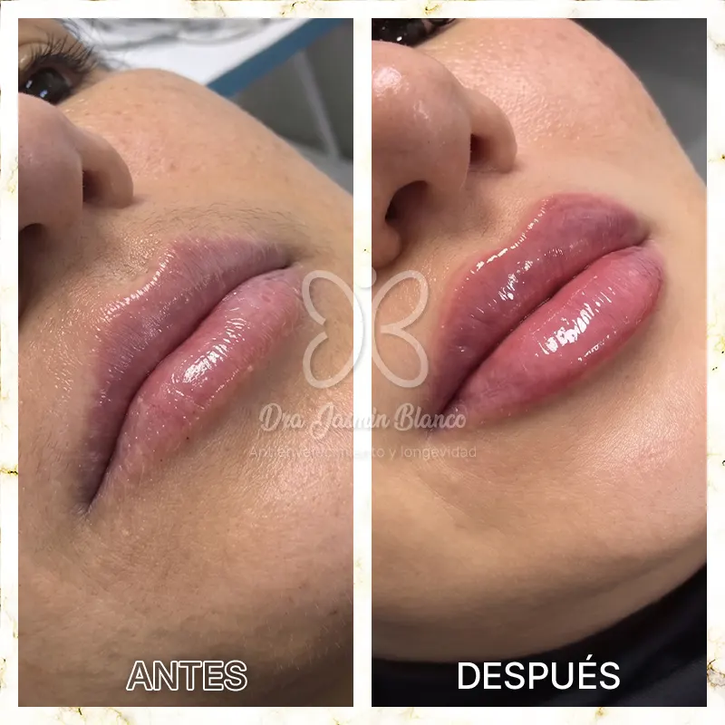 Img-Dra_Jasmin_Blanco-Antes&Despues-Acido_Hialuronico-4 Img-Dra_Jasmin_Blanco-Antes&Despues-Acido_Hialuronico-4