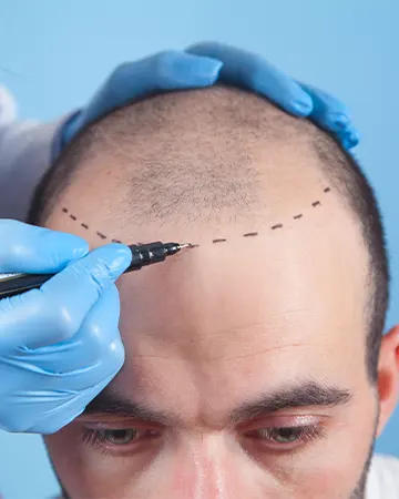 img-implante-capilar-en-bogota-1-LCP