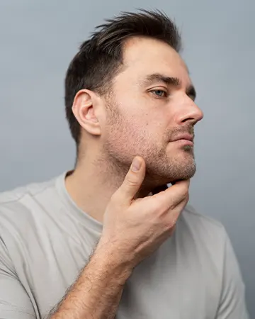 img-implante-de-barba-en-bogota-1-LCP