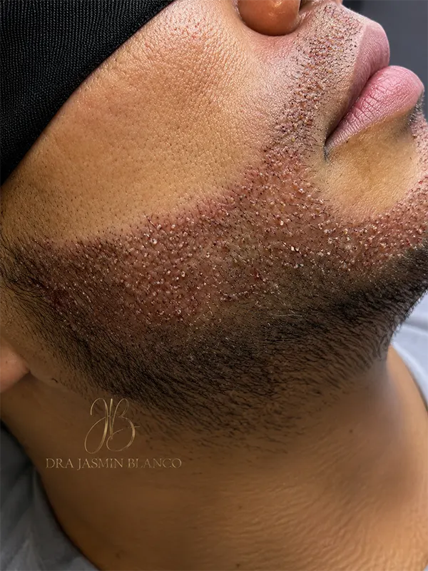 img-porque-elegirnos-implatne-de-barba-1