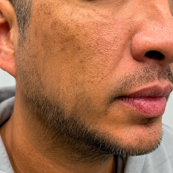 Img-Dra_Jasmin_Blanco-Implante_Barba-1 Img-Dra_Jasmin_Blanco-Implante_Barba-1