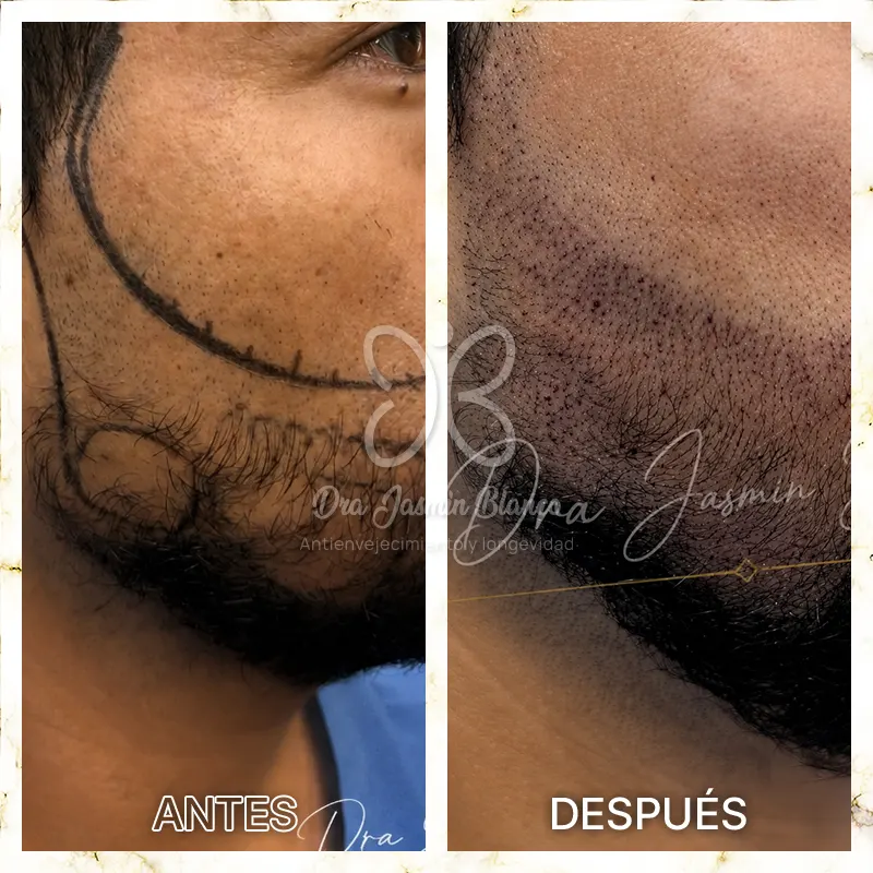 Img-Dra_Jasmin_Blanco-Antes&Despues-Barba-1