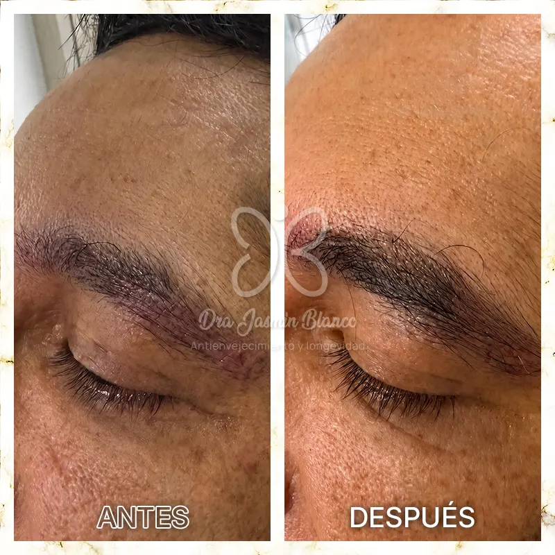 Img-Dra_Jasmin_Blanco-Antes&Despues-Cejas-1