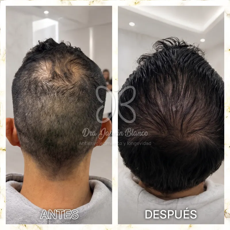 Img-Dra_Jasmin_Blanco-Antes&Despues-Terapia_Capilar-1